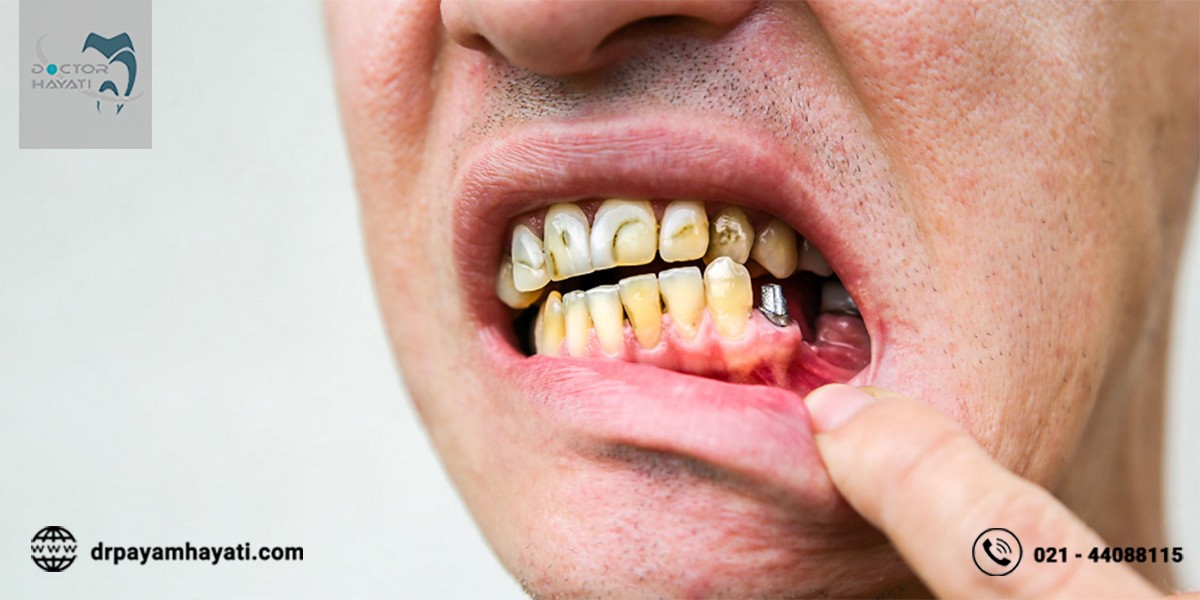 چه اطلاعاتی از عوارض ایمپلنت دندان دارید ؟