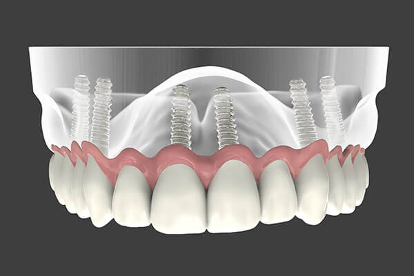 یک ایمپلنت دندانی ظاهر و احساسی شبیه دندان از دست رفته‌تان به شما می‌دهد. دندانپزشک یک پایه یا فریم فلزی را زیر لثه شما قرار می‌دهد که درست شبیه ریشه یک دندان به استخوان فک متصل می‌شود.