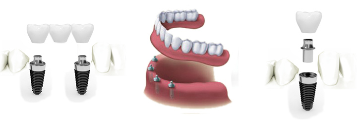 پروتز ثابت دندان همان چیزی است که در بین عموم جامعه با عنوان روکش دندان مرسوم است . 