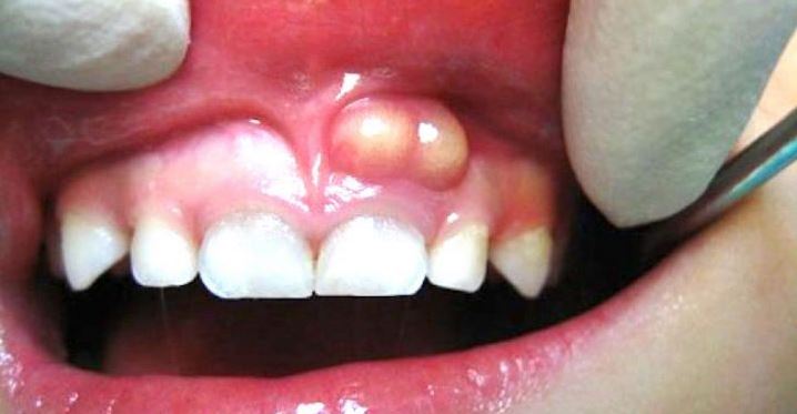 هدف از درمان آبسه دندان، برطرف کردن عفونت و چرک دندان است.