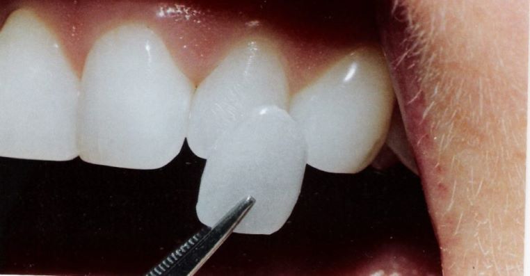 باندینگ کامپوزیت مستقیم فرآیندی است که در آن دندان‌پزشک از کامپوزیت‌های به رنگ دندان (سفید یا به رنگ طبیعی دندان‌ها) در مطب خود برای پر کردن پوسیدگی، ترمیم تراشیدگی یا ترک‌خوردگی، پوشاندن فاصله بین دندان‌ها و نیز ترمیم لبه‌های دچار خوردگی دندان‌ها استفاده می‌کند.