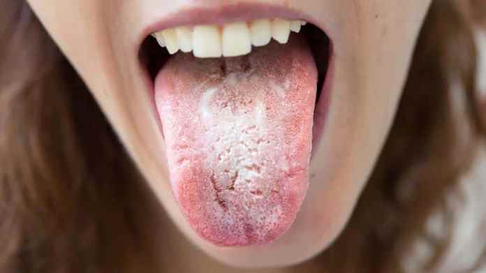 برفک دهان به یک سری عفونت‌های دهانی گفته می‌ِشود که به علت رشد بیش از حد قارچ، کاندیدا آلبیکانس، در دهان ایجاد می‌شود و در حالت عادی این قارچ در دهان بسیاری از افراد وجود دارد.