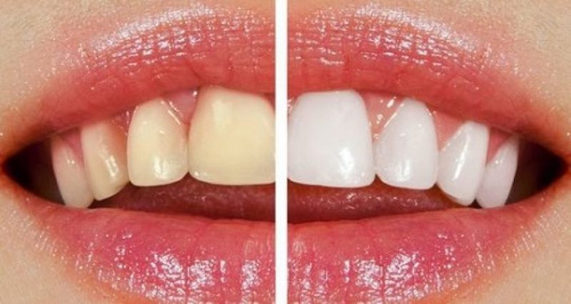بلیچینگ اگر تحت نظارت دندانپزشک باتجربه انجام بگیرد عارضه خاصی ندارد ،فقط ممکن است دندانها را تا مدتی حساس کند که این مورد نیز معمولا با خمیردندانهای ضد حساسیت قابل درمان است.