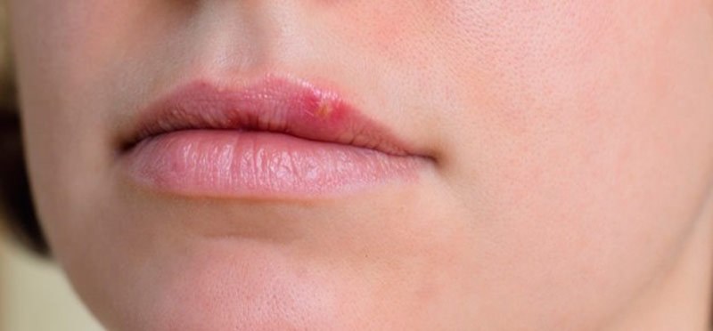تبخال دهان که به عنوان زخم سرد، تاول تب یا تبخال لبی نیز شناخته می‌شود یک عفونت ناشی از ویروس هرپس سیمپلکس است. این باعث ایجاد تاول‌های کوچک، دردناک و پر از مایع می‌شود.