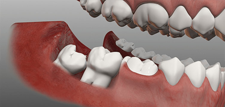 دندان عقل نهفته یا رویش یافته می تواند دندانهای مجاور را تحت فشار قرار دهد. و باعث آسیب به ساختمان آنها شود.