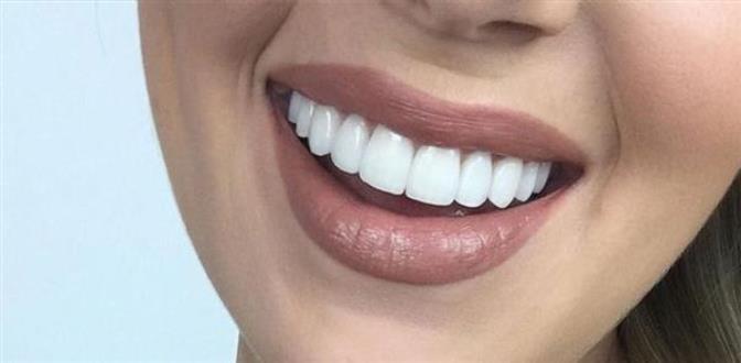 لمینیت یا لیمنت معجزه ای است برای کسانی که از لبخندی زیبا به خاطر بد شکلی و بد رنگی دندان ها محروم هستند.