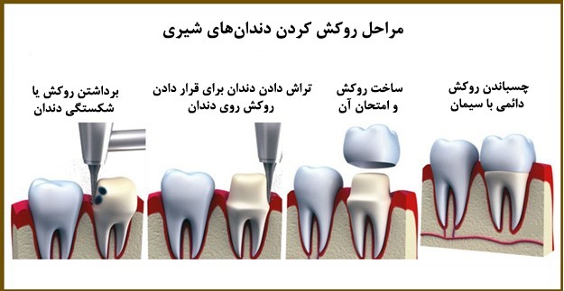 مراحل روکش دندان تصویری