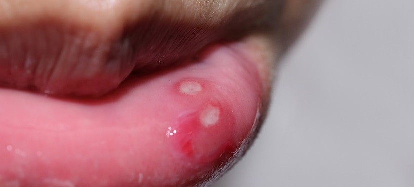 آفت دهان یک زخم دهانی در منطقه زبان، گونه‌ها ویا لثه‌ها می‌باشد. این عارضه در خانم‌ها شایع‌تر است. در حدود یک پنجم زنان و مردان جامعه به آفت مبتلا می‌شوند