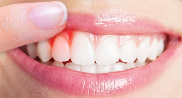 بیماری‌های پریودنتال و یا همان بیماری های لثه و بافت های اطراف دندان در صورت رعایت نکردن بهداشت ممکن است برای شما پیش بیاید که می تواند باعث التهاب و خونریزی در لثه شود 