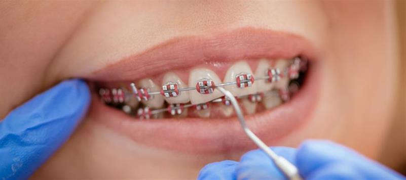 ارتودنسی دندان روشی برای بهبود عملکرد وضعیت و ظاهر دندان ها می باشد. 