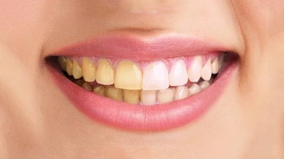 یکی از مهم‌ترین دلایل تغییر رنگ دندان پوسیدگی است. 