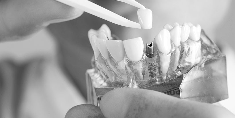 هزینه خدمات دندانپزشکی و قیمت ایمپلنت دندان همیشه نسبت به سایر خدمات پزشکی بیشتر بوده و علت آن نیز مسئولیت کاری بالایی که بر دوش دندانپزشک است و همچنین مواد و متریال گران قیمتی است که باید استفاده شود.