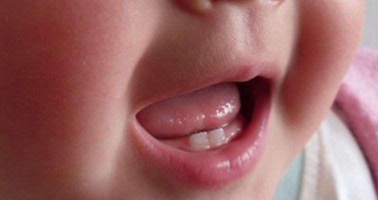 رویش دندان برای اولین بار در 6 ماهگی است . در این دوره دندان شیری که دو دندان وسط فک پایین است بعنوان اولین دندان های دیده میشوند .