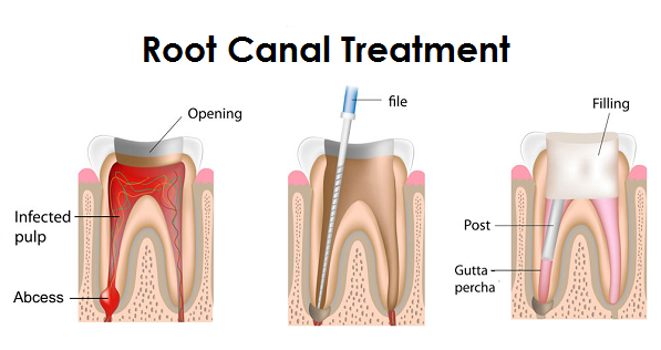 روت کانال تراپی معالجه عصب دندان (پالپ) است. درمان ریشه عملی است که در طی آن مواد عفونی و عصب موجود درمغز دندان برداشته می‌شود تا دندان از آسیب میکرب‌ها در آینده در امان باشد.