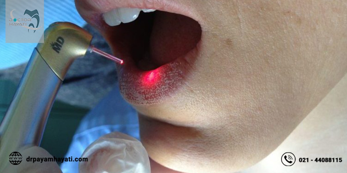 ویژگی ها و کاربردهای مهم لیزر در دندانپزشکی