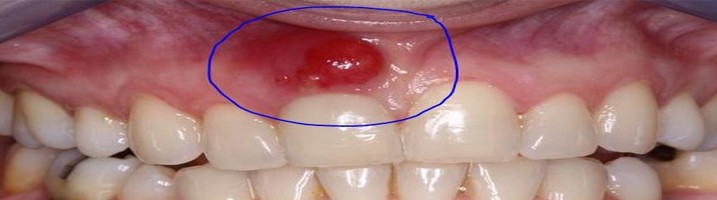 ندان های شیری در صورتی که به خوبی درمان ریشه (عصب کشی) نشوند و عفونت در ریشه هایشان باقی بماند، این عفونت می تواند به جوانه دندان دائمی زیرینش منتقل شده و جوانه دندان دائمی به کیست تبدیل شود.