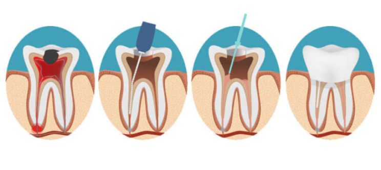 درمان مجدد ریشه در هر موردی متفاوت است و بستگی به شرایط بیمار و مهارت و تجربه دندانپزشک دارد. برخی علایم هشدار دهنده‌ ای وجود دارد که نشان می‌دهند شکست درمان قریب ‌الوقوع خواهد بود یا فاکتور خطر مهمی برای درمان مجدد وجود دارد.