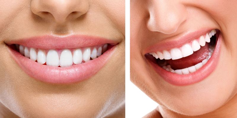 جراحی افزایش طول تاج دندان یا جراحی افزایش تاج دندان
