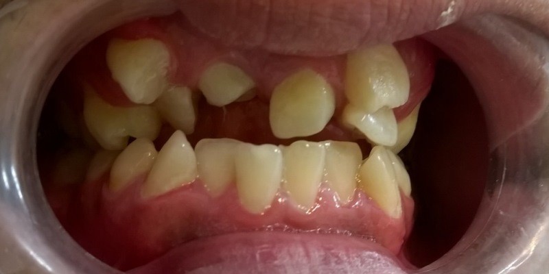 دندان اضافی
