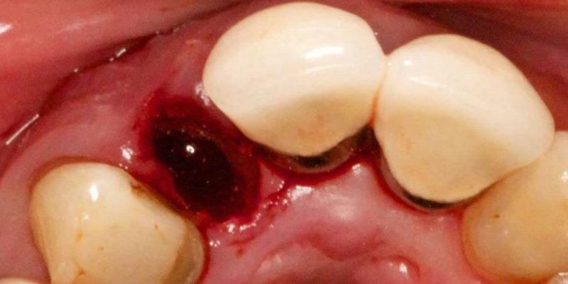 حفره خشک دندان یا درای ساکت