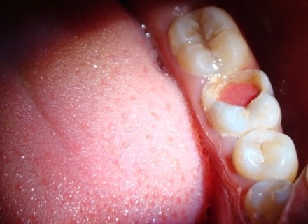 روش درمان پولیپ دندان چیست