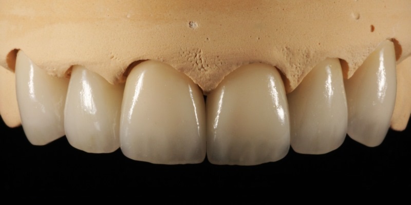 لابراتوار دندانپزشکی و مراحل ساخت دندان مصنوعی