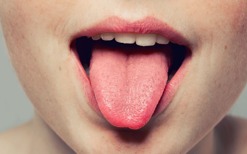 علت سوزش دهان یا علل سندرم سوزش دهان چیست ؟