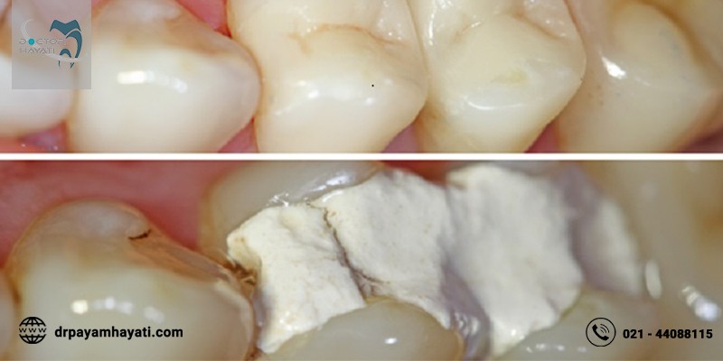 پانسمان دندان چه کاربردی دارد ؟