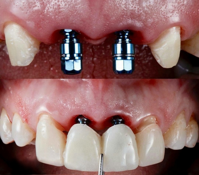 مراحل انجام ایمپلنت دندان جلو
