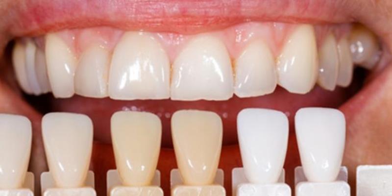 برداشتن کامپوزیت دندان و جایگزین کردن آن چگونه است