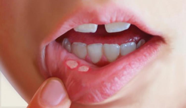 نحوه درمان آفت دهان کودکان چیست ؟