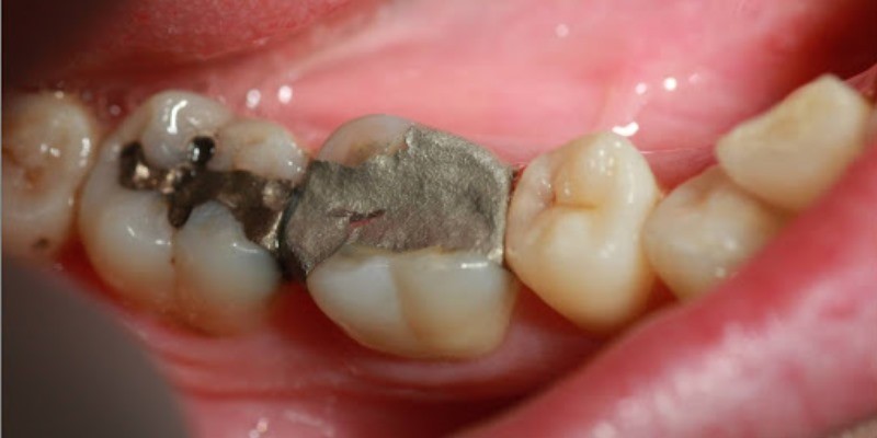 آمالگام دندانی چیست و چه کاربردی دارد