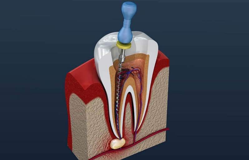 عصب کشی دندان جلو نیاز به دقت دارد