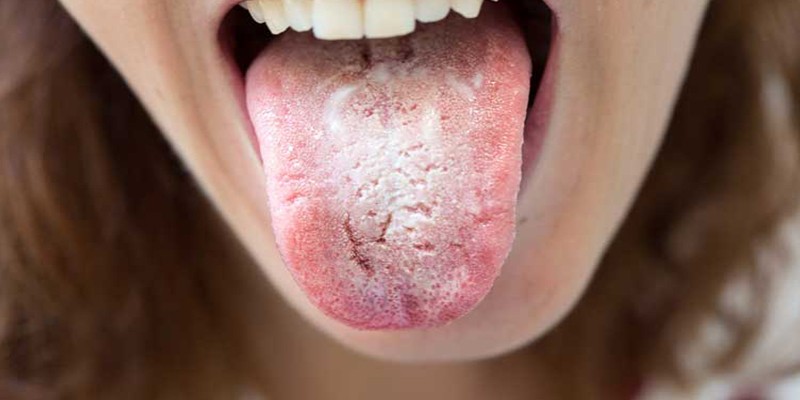 کاندیدیازیس دهانی چگونه درمان میشود