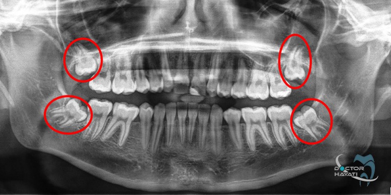 دندان عقل نهفته را چگونه میتوان درمان کرد
