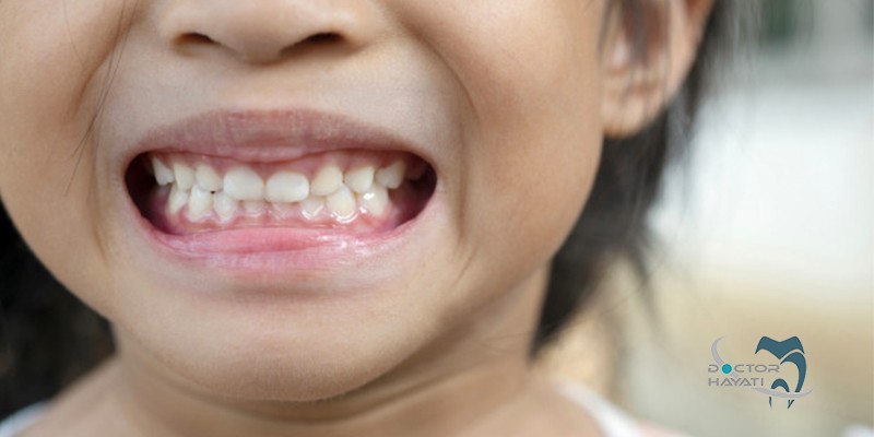 دندان قروچه کودکان چه مشکلاتی برای سلامتی دندان دارد