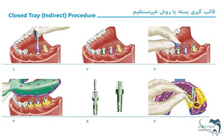 مراحل قالب گیری ایمپلنت دندان به روش تری بسته یا Close Tray