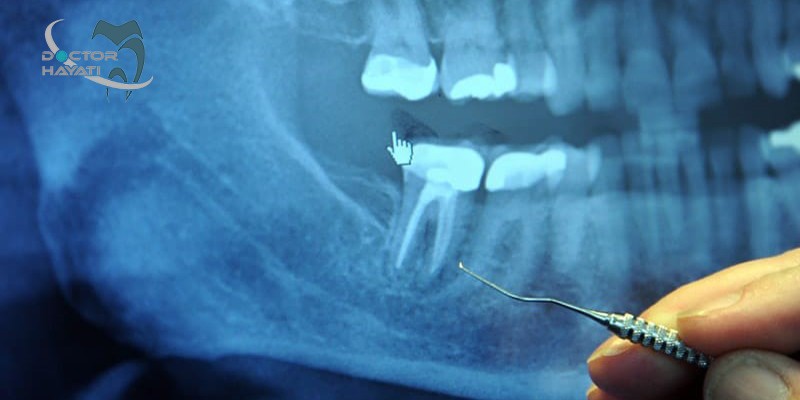 کاربرد عکس بایت وینگ در دندانپزشکی