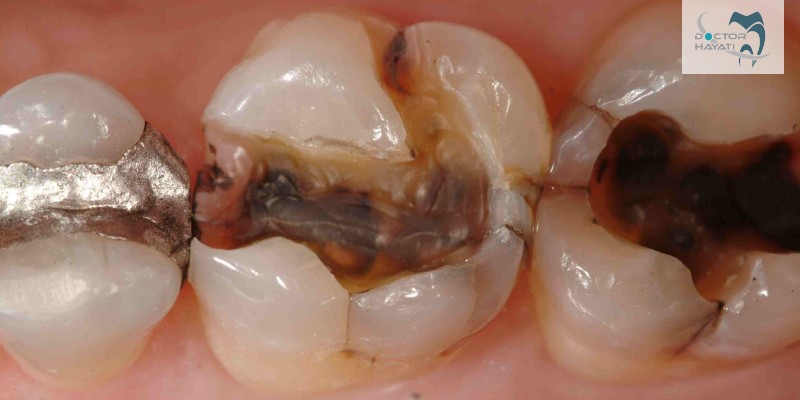 خراب شدن دندان و عادت هایی که باعث پوسیدگی و آسیب به دندان میشود