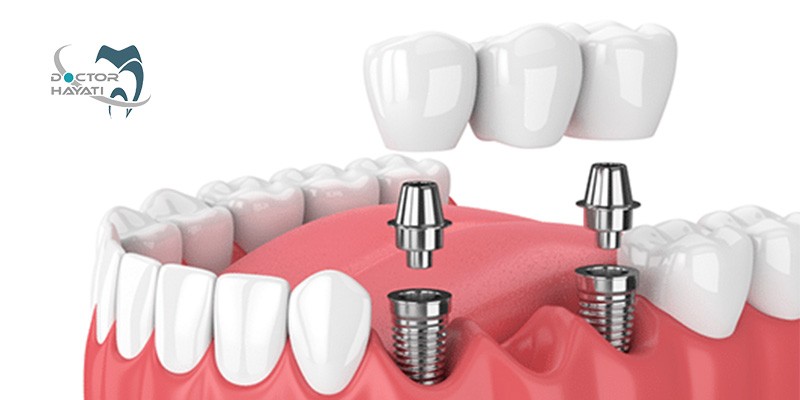 پیشتازان ساخت ایمپلنت دندان کدام کشورها هستند ؟