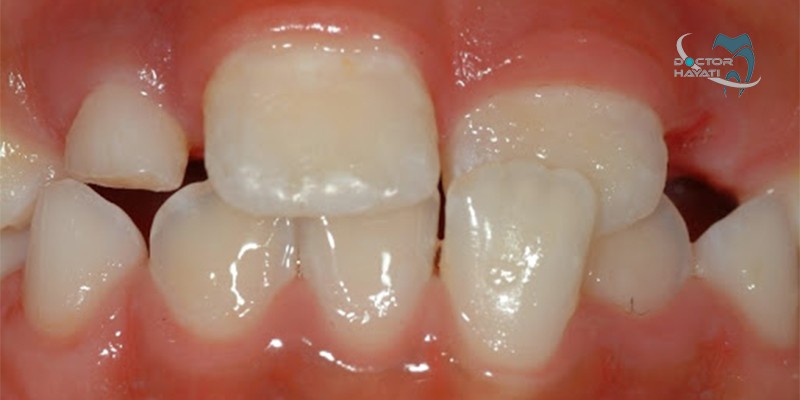 آیا میدانید کراس بایت دندان چیست و چه درمانی دارد ؟