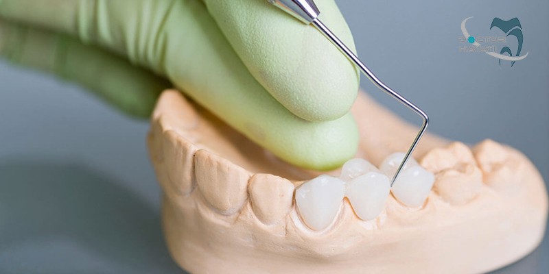 انواع بریج دندان کدام است ؟