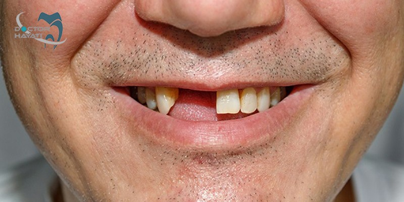 در صورت ایجاد ترومای دندانی چه کنیم ؟