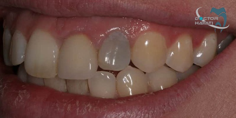 عفونت دندان روکش شده چه علایمی و نشانه ای دارد ؟