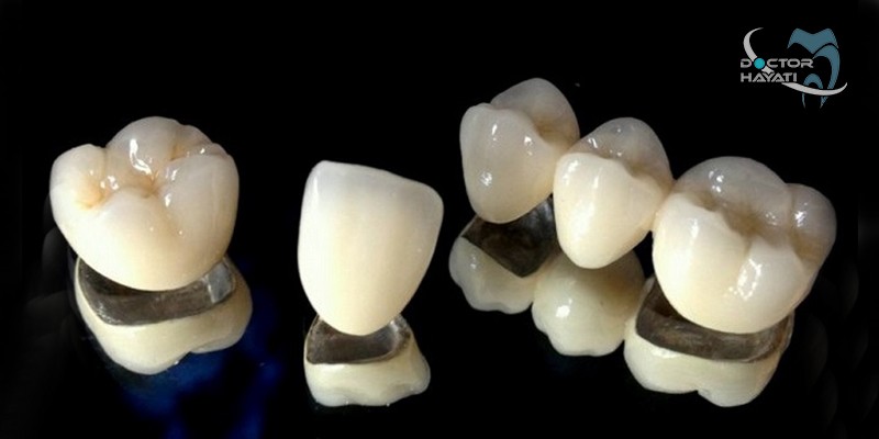چسب روکش دندان چه کاربردی دارد ؟
