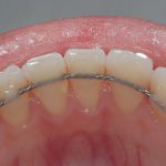 اسپلینت دندان چیست و چه درمانی دارد ؟