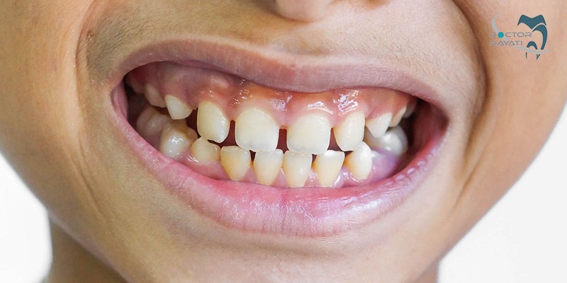 درمان دیاستما یا فاصله بین دندانی چگونه است ؟