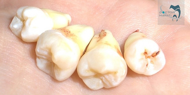 از مرگ دندان چه علایم و نشانه هایی را میشناسید ؟