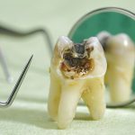 مرگ دندان چه علایم و نشانه هایی دارد ؟