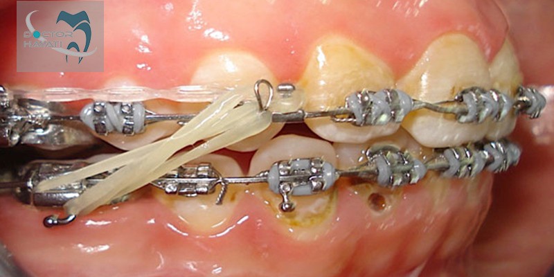 پوسیدگی دندان طی ارتودنسی به چه علتی ایجاد میشود